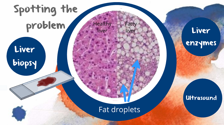 diagnosing fatty liver disease